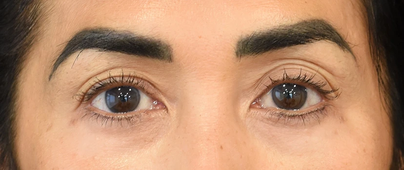 Eyelid Surgery Patient 15 Set 1 After