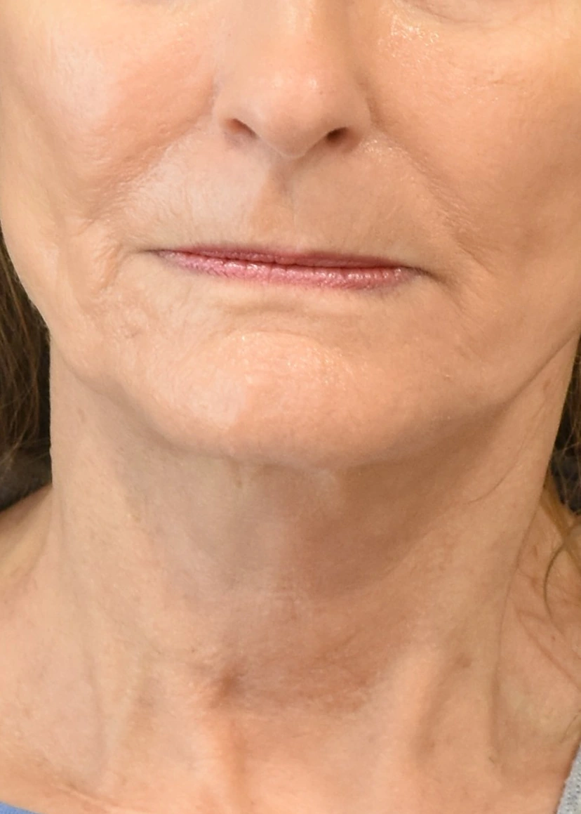 Deep Plane Facelift Patient 33 Set 1 After