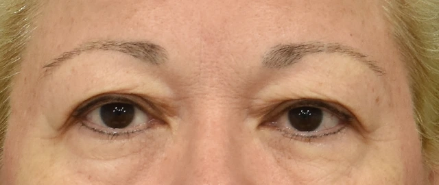 Eyelid Surgery Patient 20 Set 1 Before