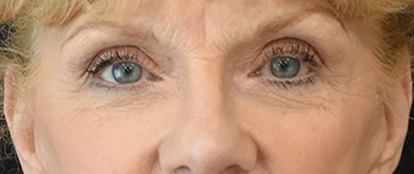 Brow Lift Patient 5 Set 1 After